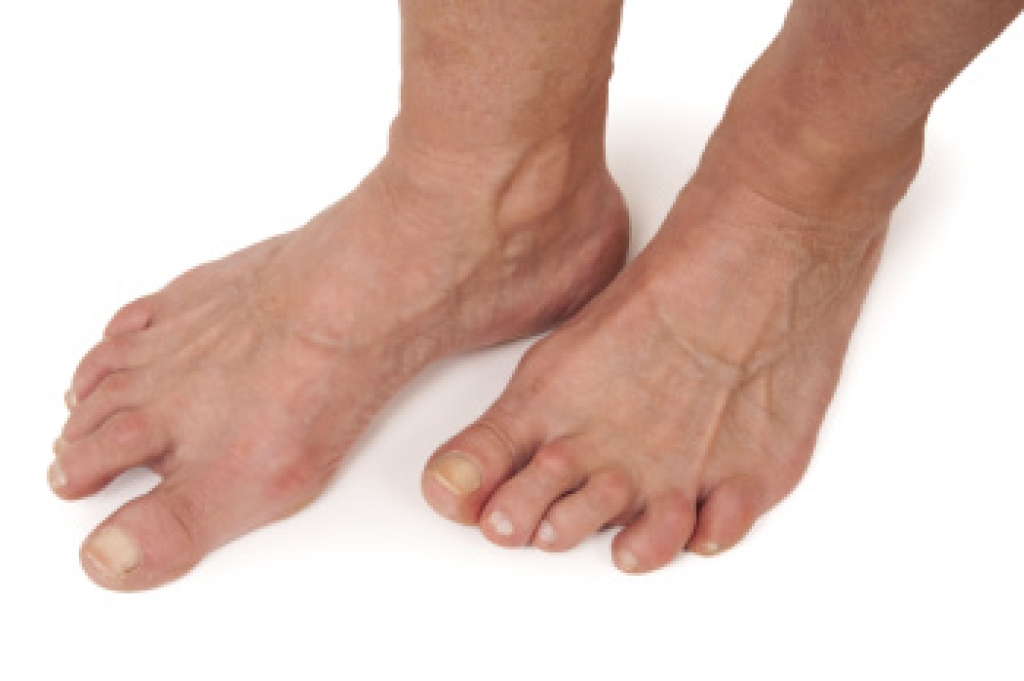 How Rheumatoid Arthritis Affects the Feet and Ankles