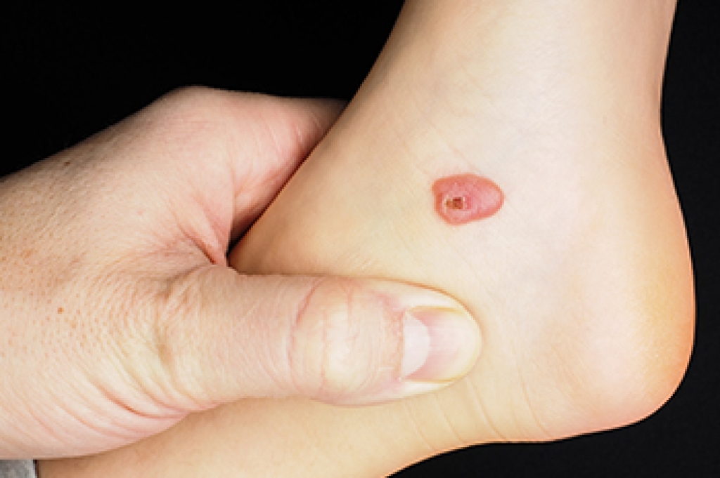 Understanding the Seriousness of Foot Blisters and When to Seek Care