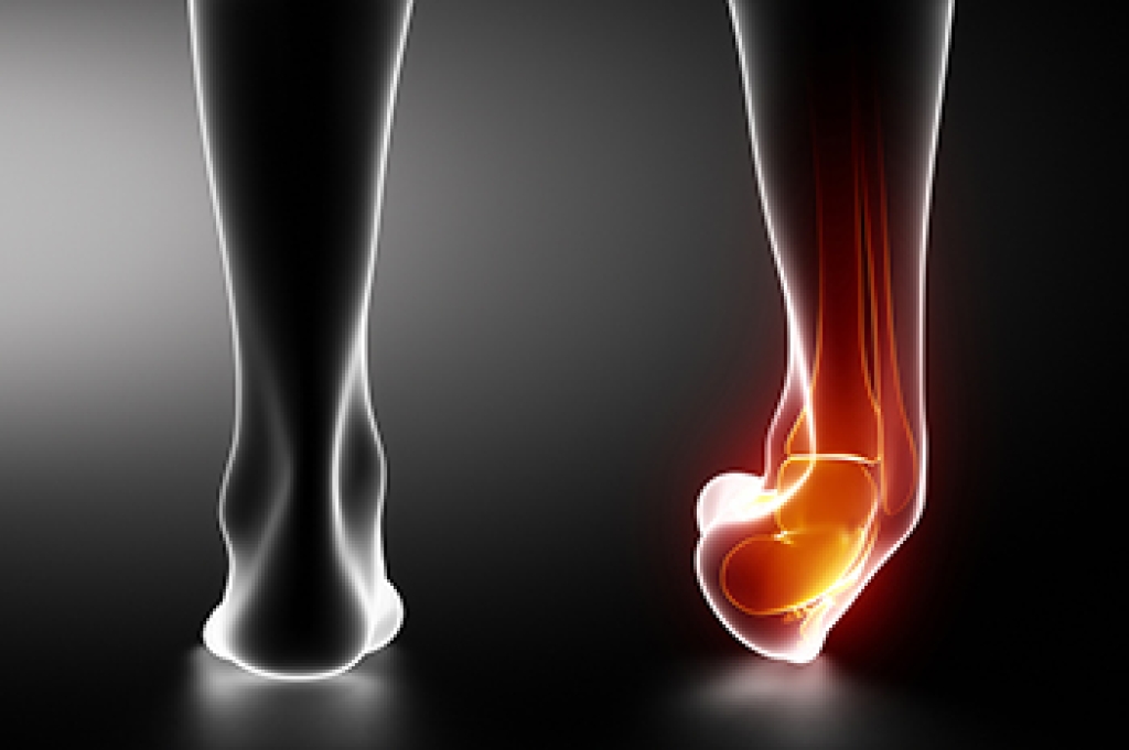 Causes of Recurrent Ankle Sprains