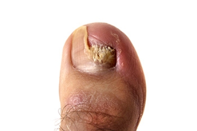 What Causes Thick Toenails?