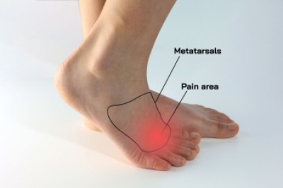 Causes and Treatment of Morton’s Neuroma