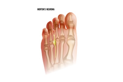 The Unseen Pain of Morton’s Neuroma
