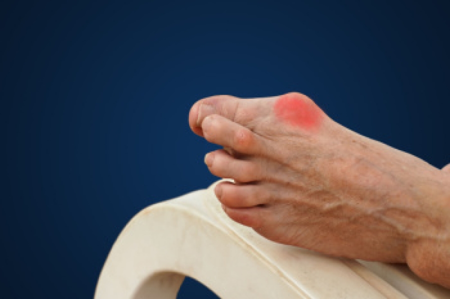 Bunions and Other Common Foot Issues